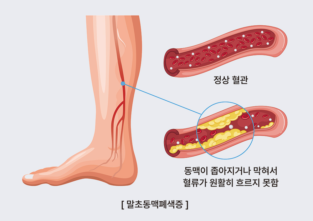 말초동맥폐색증, 정상 혈관, 동맥이 좁아지거나 막혀서 혈류가 원활히 흐르지 못함