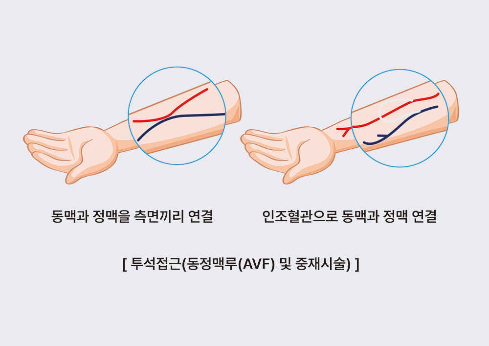 투석접근(동정맥루(AVF) 및 중재시술), 동맥과 정맥을 측면끼리 연결, 인조혈관으로 동맥과 정맥 연결