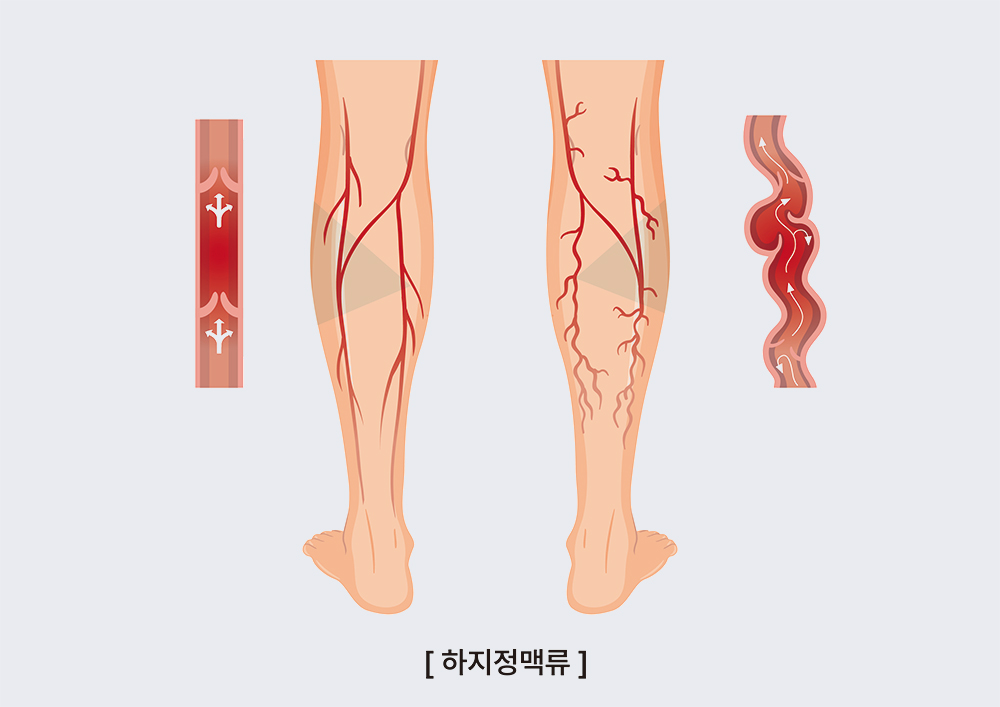 하지정맥류