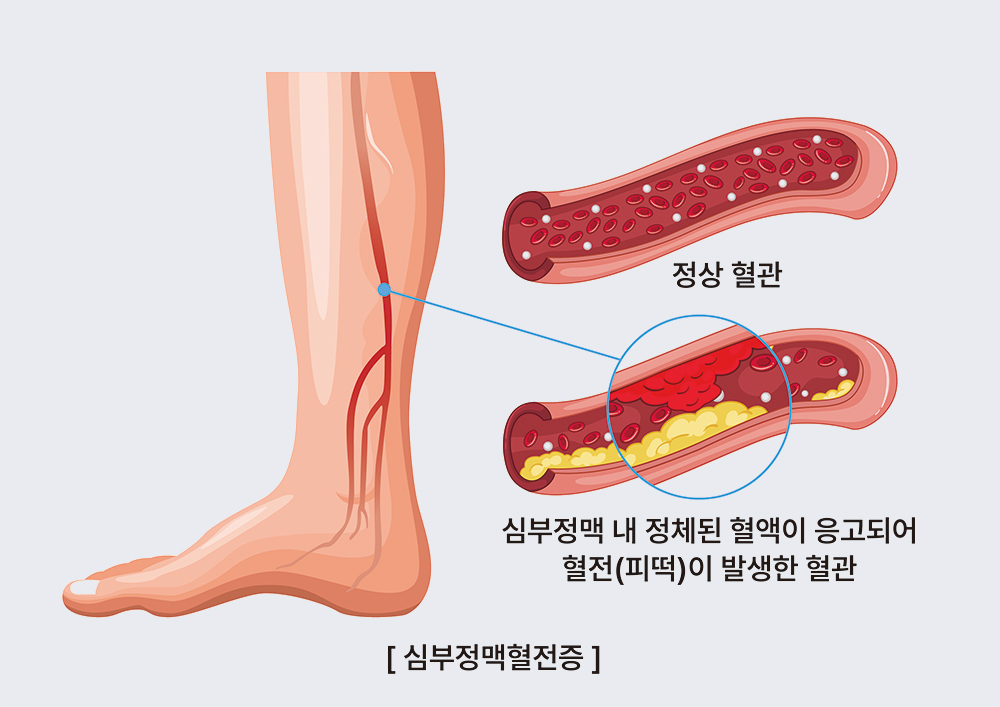 심부정맥혈전증