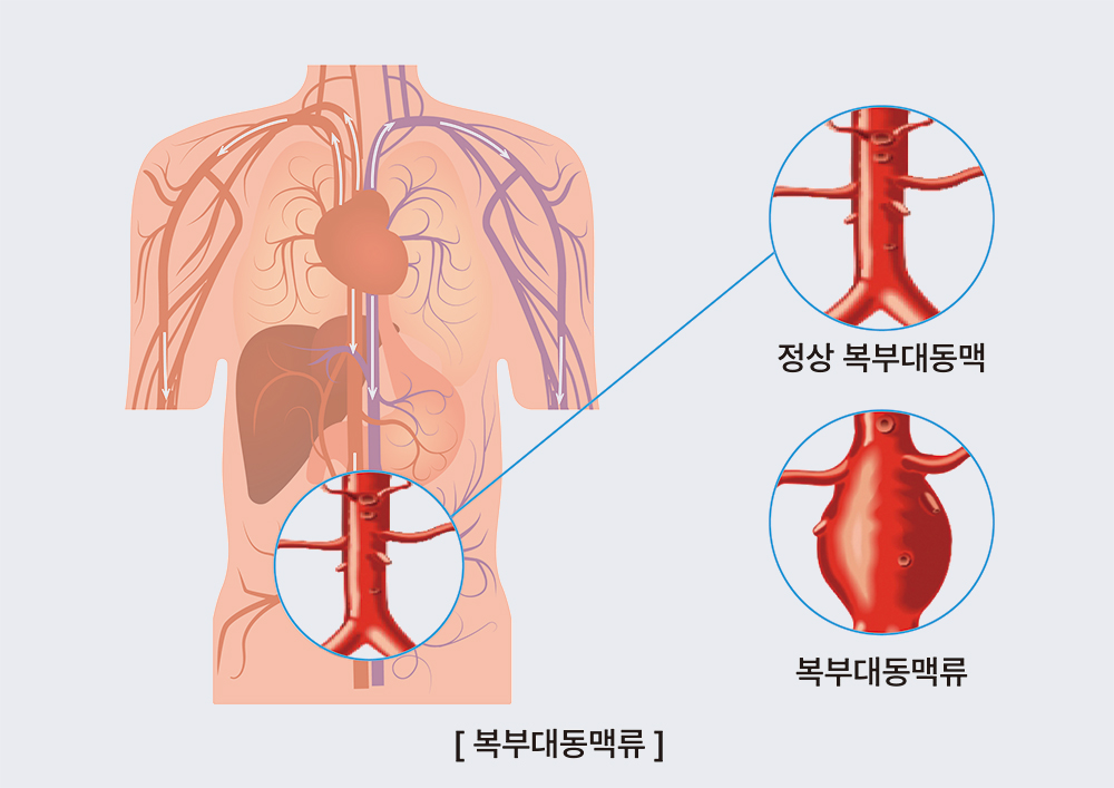 복부대동맥류