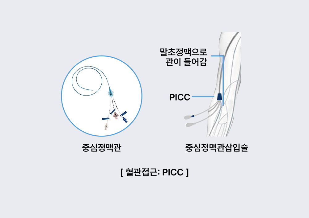 혈관접근
