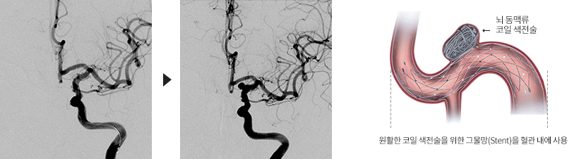 뇌동맥류 코일색전술 : 원활한 코인 색전술을 위한 그물망(Stent)을 혈관 내에 사용